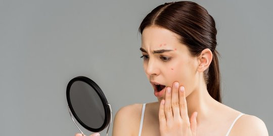 Hati-hati, Bisa Jadi Jerawatmu Termasuk Fungal Acne