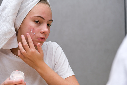 5 Penyebab Kulit Tetap Berjerawat Meski Sudah Gunakan Anti Acne