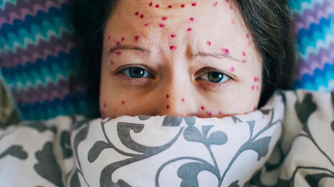 Terkena Cacar Air, Begini Cara Penangananya