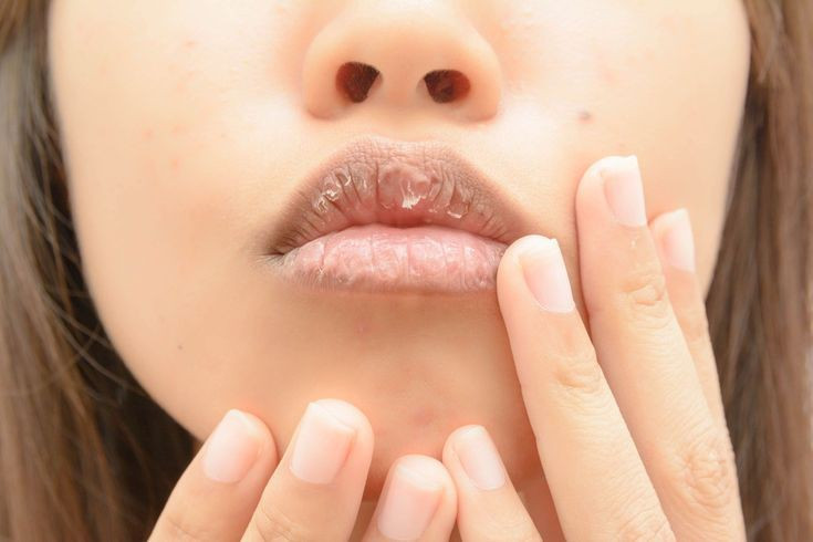 Hindari 5 Kebiasaan Sebabkan Bibir Kering Dan Pecah-Pecah