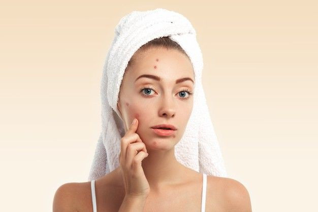 Hindari! 5 Kesalahan Penggunaan Skincare Yang Bikin Jerawat Semakin Meradang