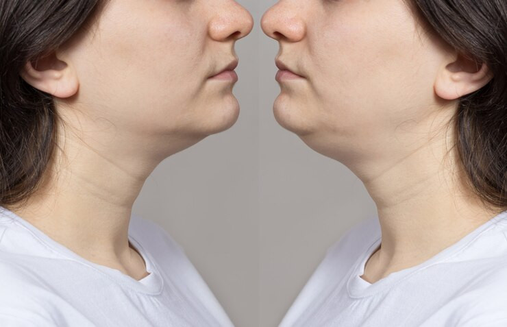 Bikin Gak Pd, Ini Latihan Yang Dapat Dilakukan Untuk Hilangkan Double Chin