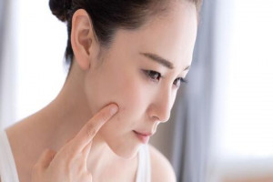 5 Cara Alami untuk Hilangkan Flek Hitam di Wajah