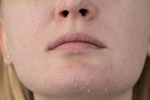 Cocok Tuk Kulit Kering dan Sensitif, Ini Manfaat Alpha Arbutin dalam Skincare