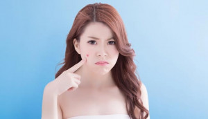Lebih Cerdas Pilih Acne Patch, Sesuaikan Dengan Kebutuhanmu