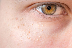 5 Cara Hilangkan Milia di Wajah Dengan Mudah