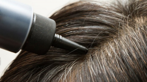 Fenomena Baru Transplantasi Rambut, Apakah Aman?