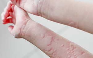 5 Bahan Alami Jadi Obat Atasi Biduran di Kulit