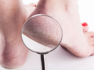 Sering Dikeluhkan, 5 Penyebab Telapak Kaki Pecah-pecah