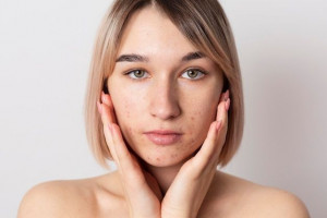 Hati-hati, Ini Kandungan Skincare yang Wajib Dihindari oleh Kulit Sensitif