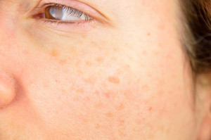 Mengenal Keratosis Pilaris, Penyakit Bintik di Wajah