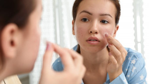 Ini Cara Kerja Acne Patch untuk Redakan Jerawat di Kulit Wajah