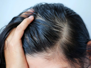 Jangan Transplantasi Rambut dari Orang Lain, Ini Alasannya