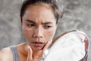 6 Kandungan Skincare yang Dapat Atasi Masalah Dark Spot
