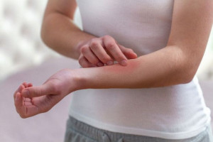 5 Obat Alami Bantu Obati Kudis dan Redakan Gatal