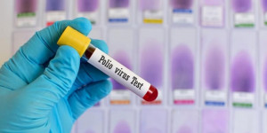Kenali Jenis Polio, Gejala, hingga Cara Pengobatannya