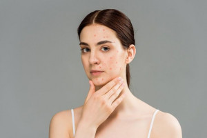 Kulit Acne Prone, Hindari Makeup Berbahan Silikon untuk Cegah 5 Masalah Ini
