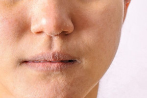 6 Cara Bantu Atasi Kulit Hidung yang Mengering Akibat Cuaca Dingin
