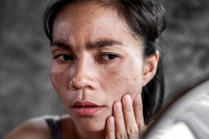 5 Cara Hilangkan Flek Hitam Wajah dengan Bahan Alami, Mudah Lho!