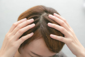 5 Cara Menghilangkan Ketombe Secara Alami, Hanya Perlu Bahan Rumahan!