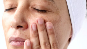 5 Cara Hilangkan Melasma dengan Bahan Alami, Bisa Dilakukan di Rumah!