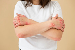 Penurunan Berat Badan Bantu Obati Psoriasis? Simak Penjelasannya!
