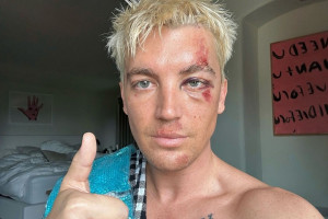 Paul Klein Alami Kecelakaan, Konser LANY di Australia Terpaksa Ditunda