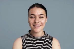 8 Ciri-Ciri Kulit Sensitif pada Wajah