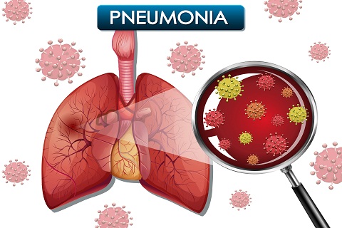 Apa Itu Pneumonia? Cari Tahu Cara Mengatasinya