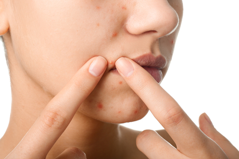5 Rekomendasi Skincare Yang Bagus Untuk Menghilangkan Bekas Jerawat